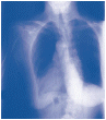 An&aacute;lisis de laboratorio de fluidos o tejido de los pulmones.