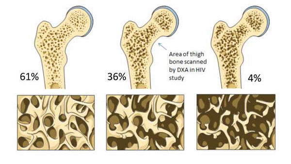 Normal Bone, Osteopenia and Osteoporosis