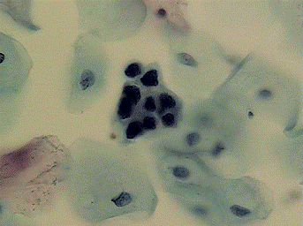 Advanced Precancerous Cervical Cells