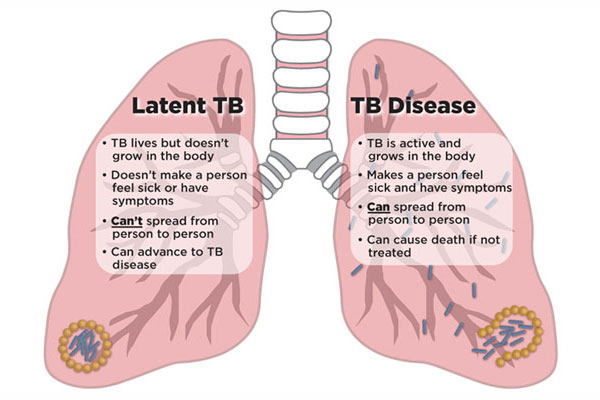 hiv-and-tuberculosis-tb-thebody