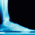 X-Ray of the foot