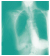 ?La TB afecta s�lo los pulmones?