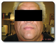 Banishing Chipmunk Cheeks and Bullfrog Neck