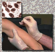 Smallpox Vaccination and the Patient With HIV/AIDS