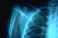 Article: Building Better Bone