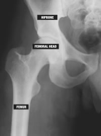 Article: Osteonecrosis and HIV Disease