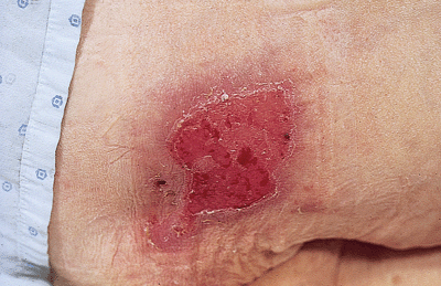 Pressure Ulcers: Prevention, Evaluation, and Management ...
