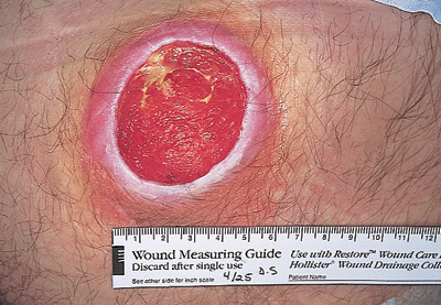 Sacral Ulcer