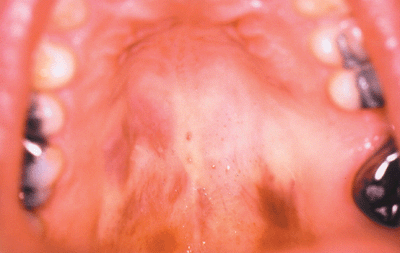 lesions in mouth