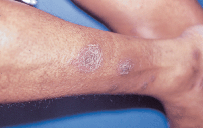 Rashes affecting the lower legs | DermNet New Zealand