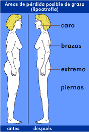 �reas de perdida posible de grasa (lipoatrofia)
