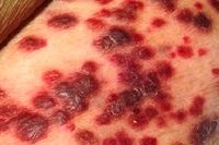 Kaposi's sarcoma