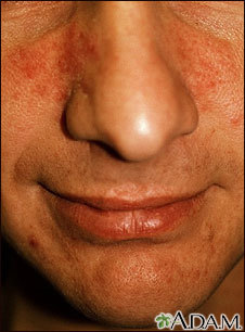 Justin vs. Rosacea
