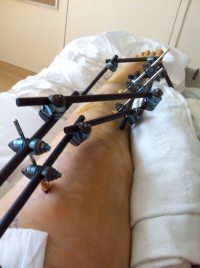 Betsy's leg with external fixator