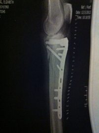 Xray of Betsy's leg