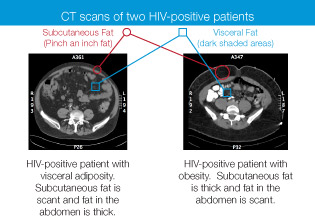 CT scans of two HIV-positive patients