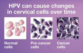 Hpv that causes abnormal cells Human papillomavirus infection abnormal cells