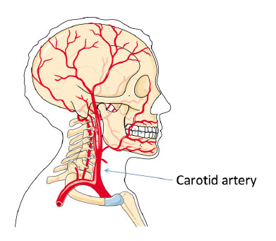 Early Artery Thickening in Middle-Aged With HIV and Low Overall Heart ...