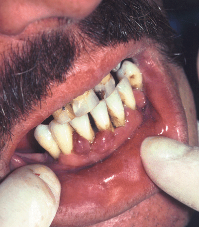 hiv symptoms on lips