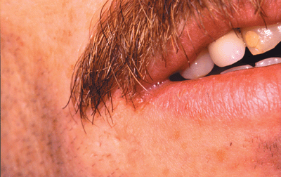 hiv symptoms on lips
