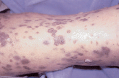 Hiv Lesions On Arm