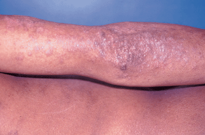 Tinea Corporis - WideSpread 