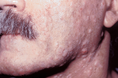 hiv lesions neck